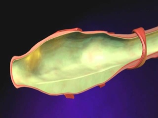 Bronchiectasis Animation - What is Bronchiectasis