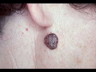DermTV - What Are Seborrheic Keratosis [ Epi #342]